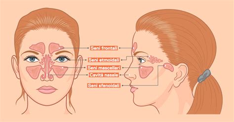 Sinusite Come Riconoscerla E Curarla