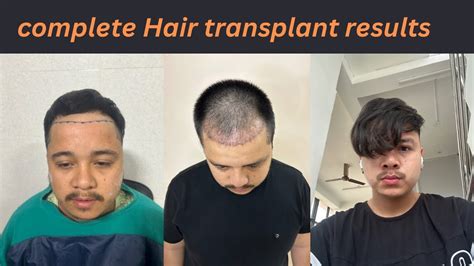 Complete Hair Transplant Results Rabin Thapa Hair Transplant In