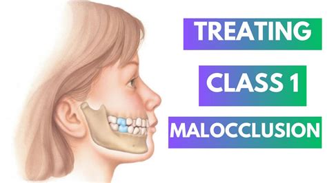 Management Of Class 1 Malocclusion Orthodontics Youtube