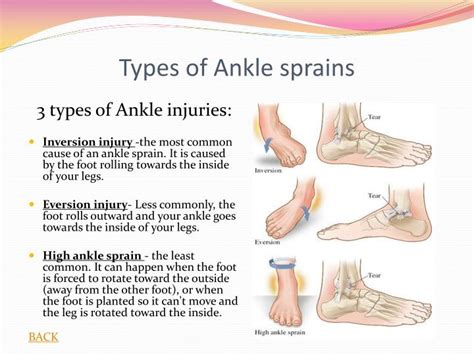 Types Of Ankle Sprains