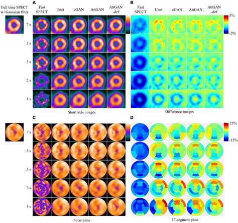 Frontiers Fast Myocardial Perfusion Spect Denoising Using An