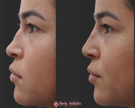 Non Surgical Rhinoplasty Before And After Results