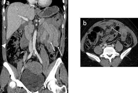 Significant Blunt Bowel And Mesenteric Injury Comparison Of Two CT