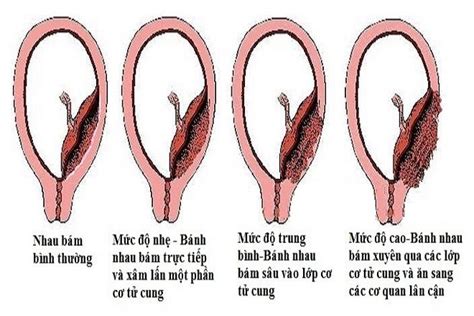 Nhau thai là gì các vấn đề về nhau thai mẹ bầu cần biết BvNTP