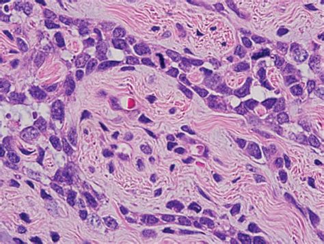 A Photomicrograph Showing A Neoplasm Predominantly Composed Of