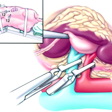 Retroperitoneal Laparoscopic Partial Nephrectomy Because Of Limited