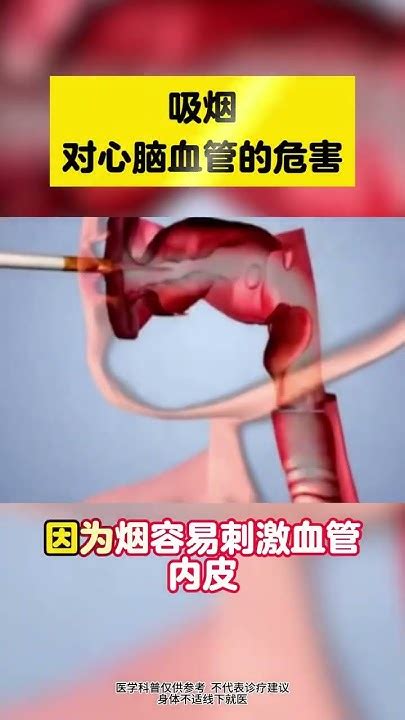 血管堵塞不要慌，3个小妙招，血管变通畅 健康 Youtube