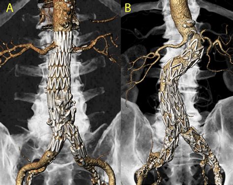 tips  techniques  optimal stent graft placement  angulated