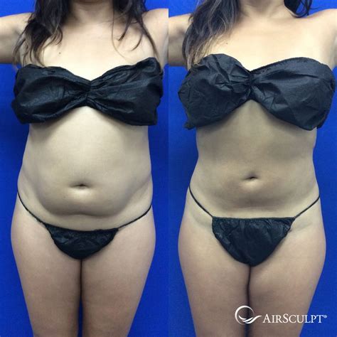 Pin On Airsculpt® Before And After Elite Body Sculpture