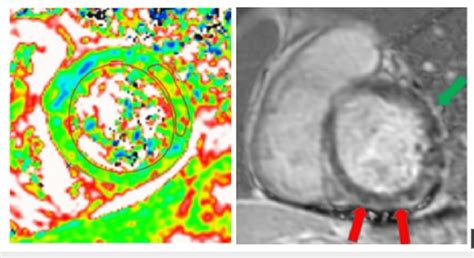 Left Cardiac Mri Displaying Myocardial Edema On T2 Weighted Images