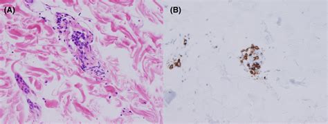 Random Skin Biopsy Hematoxylin And Eosin Stain Showing Malignant Cells