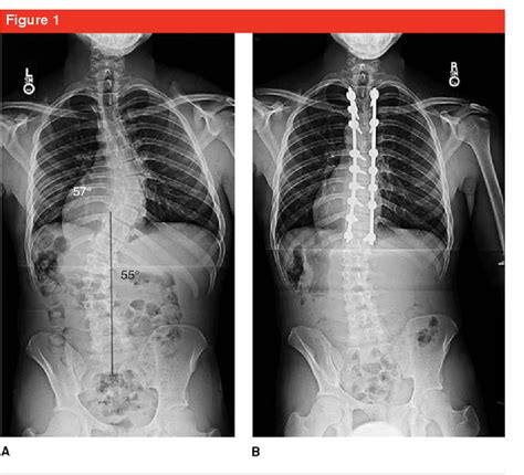 Pdf Choosing Fusion Levels In Adolescent Idiopathic Scoliosis