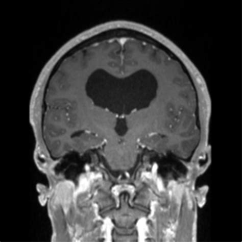 Tectal Plate Glioma Image