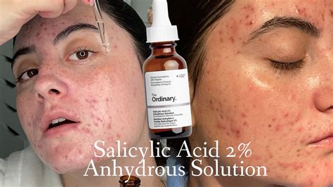 Salicylic Acid Acne Before And After