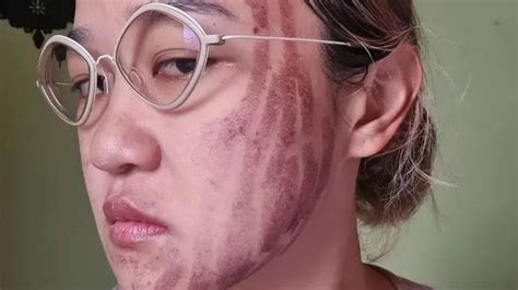 Woman suffers nasty burn scars across her entire face after botched ...