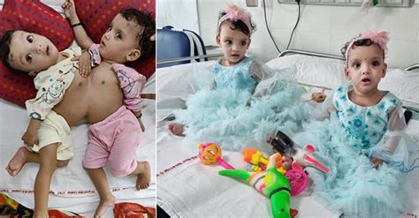 UP Conjoined Twins Separated After Successful Surgery By AIIMS Delhi