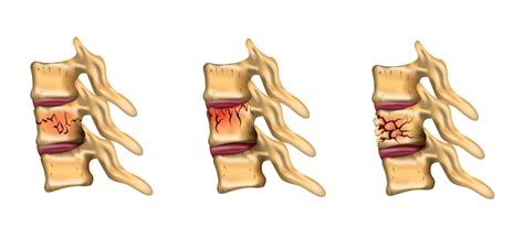 13 Vertebral Compression Fracture Symptoms To Watch For | Arizona Pain