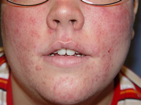 Rosacea Dermatology Practice Of Roanoke