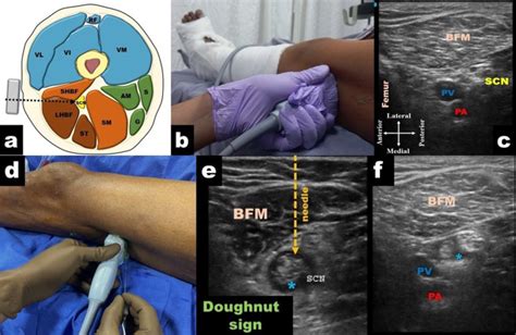 Popliteal Sciatic Nerve Block Springerlink Hot Sex Picture