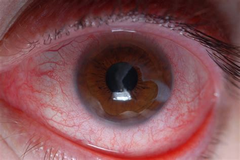 Traumatic Eye Injury Management Principles For The Prehospital Setting Jems Ems Emergency