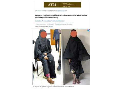 congenital tallipes equinos varus Club Foot.pptx