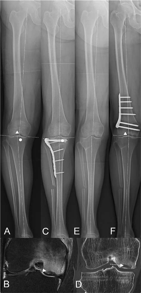 Additional DFO Case 3 In Table 1 A Full Length Anteroposterior