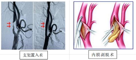 脑卒中健康科普之颈动脉狭窄 遵义医科大学附属医院