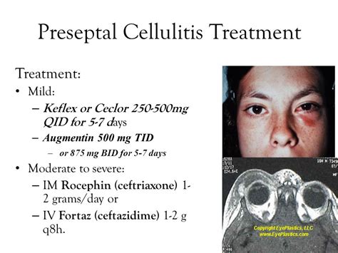 Antibiotics facial cellulitis