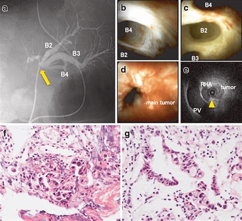 A Cholangiography Via An Endoscopic Nasobiliary Drainage Enbd Tube