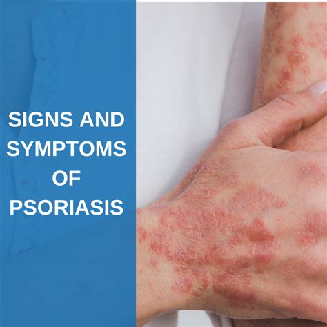 Signs and Symptoms of Psoriasis - Savannah River Dermatology