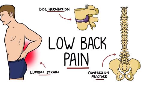 Decoding Low Back Pain: Causes, Symptoms, and Treatmen