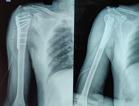 Proximal humerus fracture - tatkanic