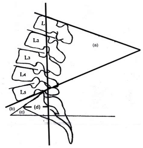 Figure 1 Defined Angles As A Lumbar Lordosis Angle LLA B