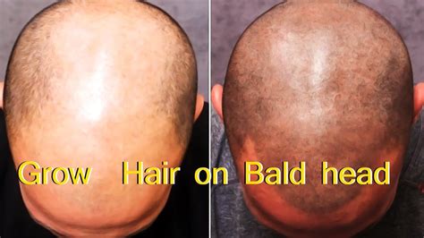 Is It Possible To Regrow Hair On Bald Head - The 2023 Guide to the Best ...