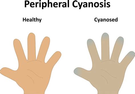 Central Cyanosis Vs Peripheral Cyanosis