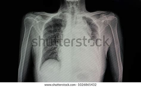 Chest Xray Film Patient Cardiomegaly Left Stock Photo Edit Now 1026865432