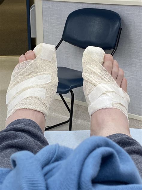 Update : r/Ingrown_Toenails