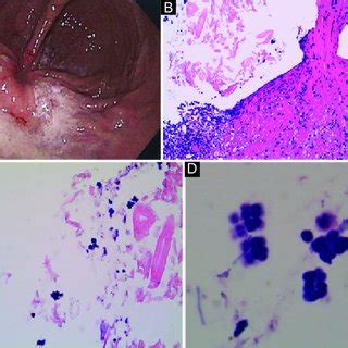 Pdf Gastric Sarcina Ventriculi Incidental Or Pathologic