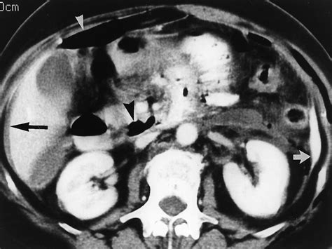 CT Of Blunt Trauma Bowel And Mesenteric Injury Typical Findings And