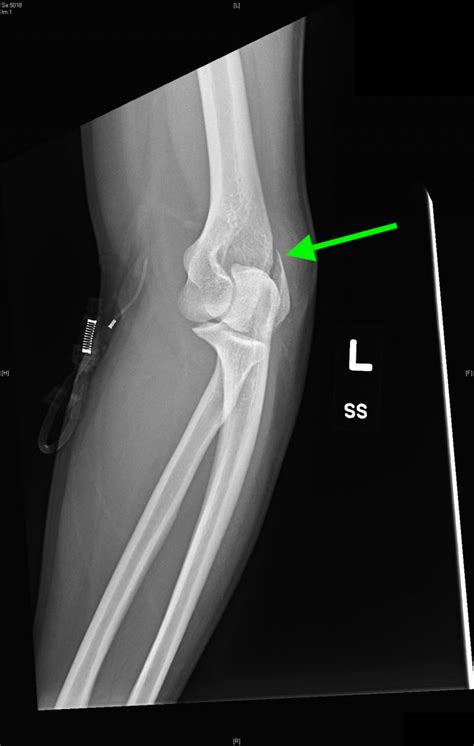 Lateral Epicondyle Fracture Left Elbow Xr Annotated Jetem 2018 Jetem