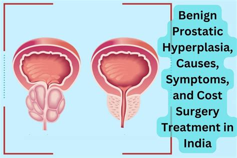 Benign Prostatic Hyperplasia Causes Symptoms And Cost Surgery Treatment