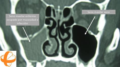 Cirugía Endoscópica Nasosinusal para el Tratamiento de la Sinusitis