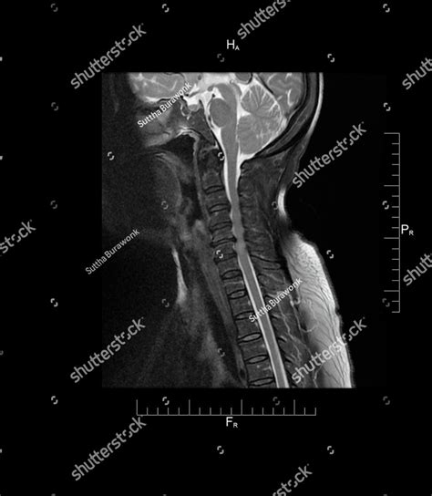 MRI of cervical spine (C-spine), sagittal view, case of neck pain, a 60 ...