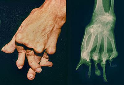 Rheumatoid Arthritis Symptoms : Johns Hopkins Arthritis Center