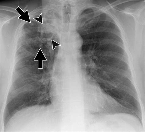 Pulmonary Tuberculosis Chest X Ray