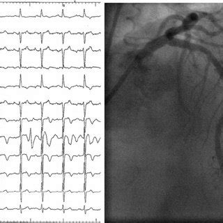 Resolution of coronary spasm and return of ECG to baseline within ...