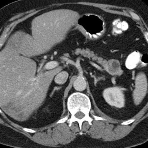 Initial Ct Image Of The An Incidental Cm Complex Cyst In The