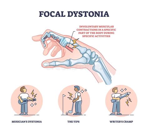 Focal Dystonia As Anatomical Neurological Muscle Disorder Outline Diagram Stock Vector ...