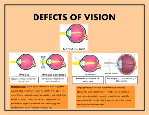 Defects Of Vision Faczc Z Defects Of Vision Myopia Is Also Called Near Sightedness Myopia