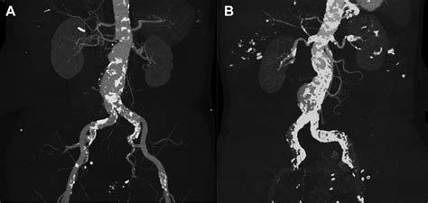 The Prognostic Impact Of Vascular Calcification On Abdominal Aortic